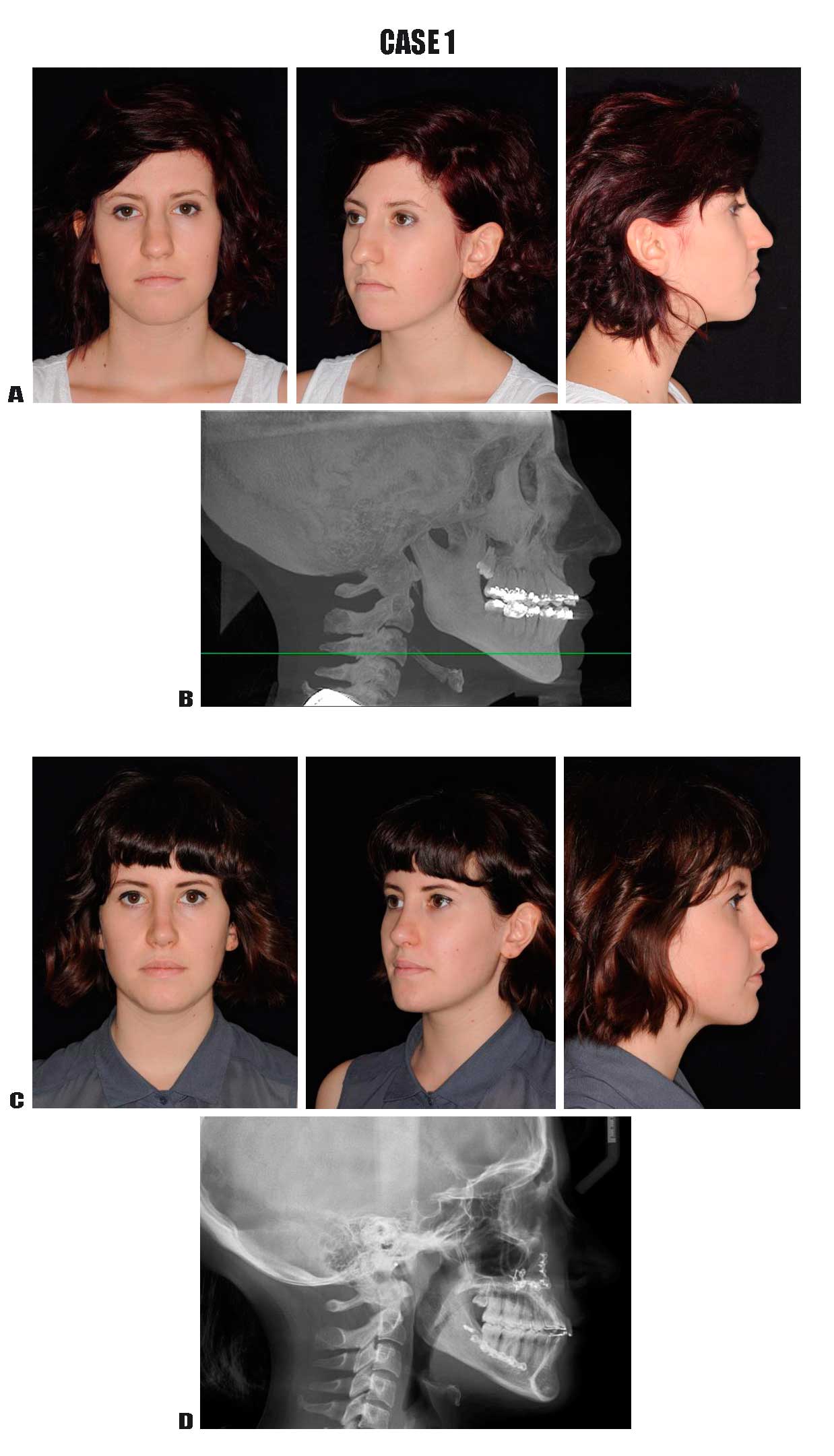 At 12 months postoperative photographs showing straight neck with a
