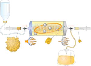 Figure 2. Schematic representation of Lipogems device. Lipogems® is a closed and immersion system. The inlet tube (blue cap) is connected to a saline bag and an outlet tube (grey cap) is connected to a urine waste bag. After making a complete filling with saline removing all air, lipoaspirates are inserted through first filter in the device. The port is completely closed by an automatic valve the transfer of the fat through the first filter create a first volumetric reduction and eliminates fibrotic tissue frustules. In next step surgeon agitates the system equipped of five stainless steel balls inside which allows oil/physiologic emulsion to be created and washed away by the flux against the gravity in the waste bag. As soon as the adipose tissue appears completely clean a second volumetric reduction of adipocyte cluster through the second filter is performed and final Lipogems® tissue is collected in the syringe.